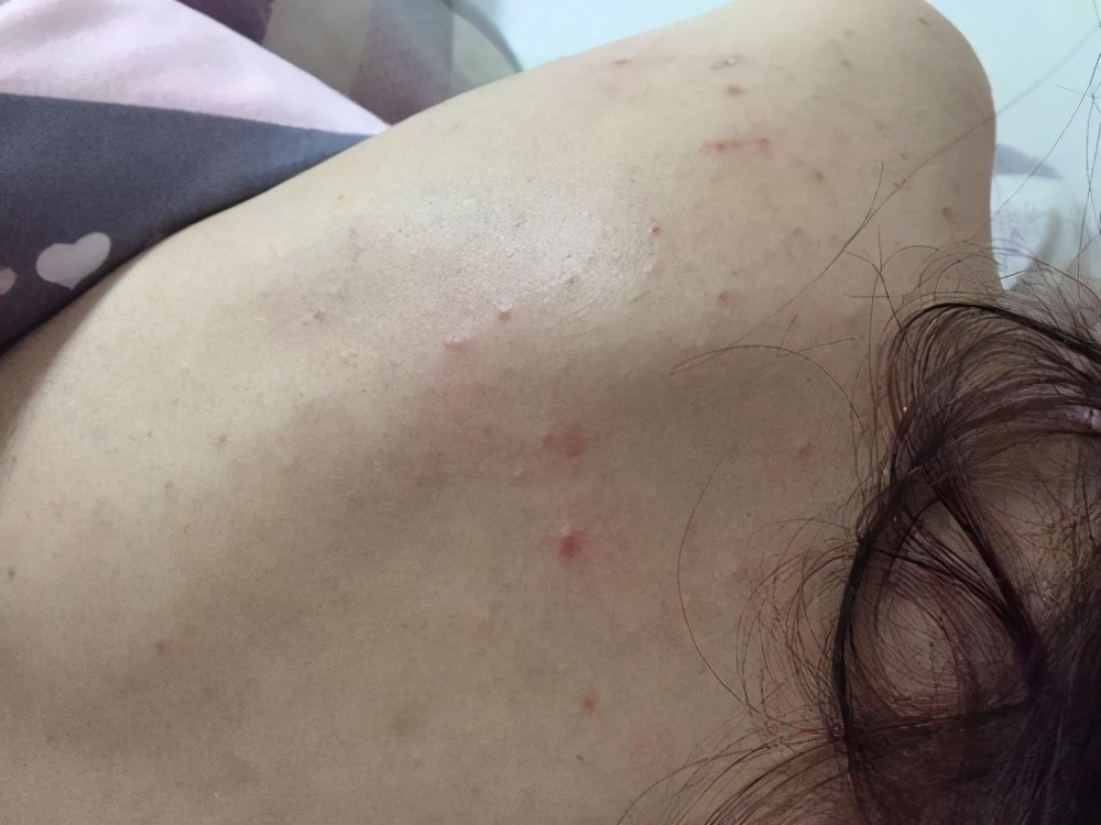 敏感性痘痘肌如何护肤,敏感性痘