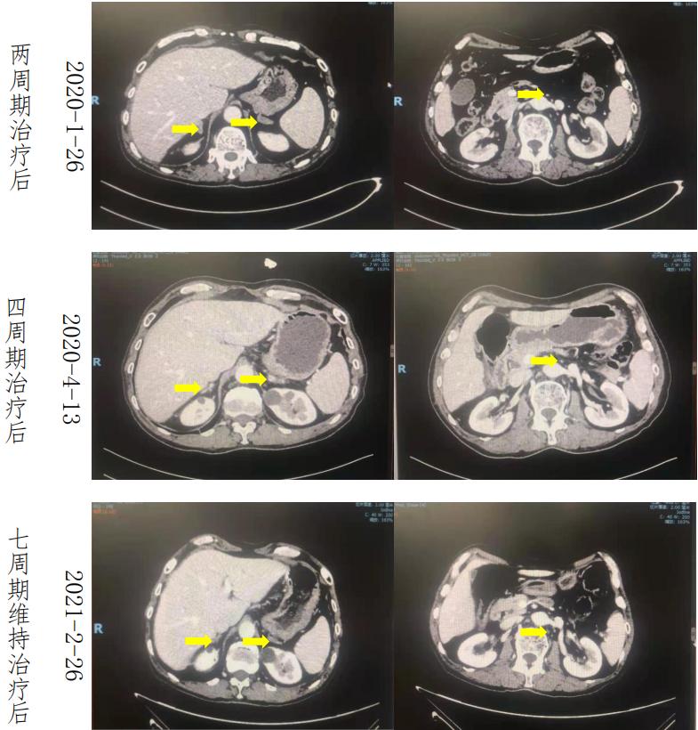 六旬男子小肠癌晚期，经化疗联合免疫治疗后疾病获得长期缓解。免疫治疗或将成为肠癌重要的治疗手段