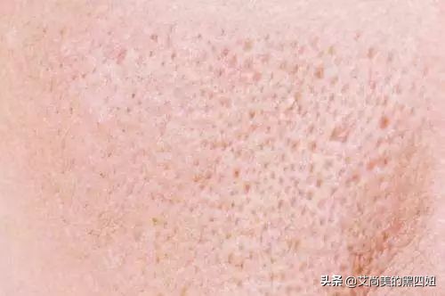 角质堵塞毛孔粗大怎样收缩毛孔,男人面部毛孔粗大怎么收缩毛孔