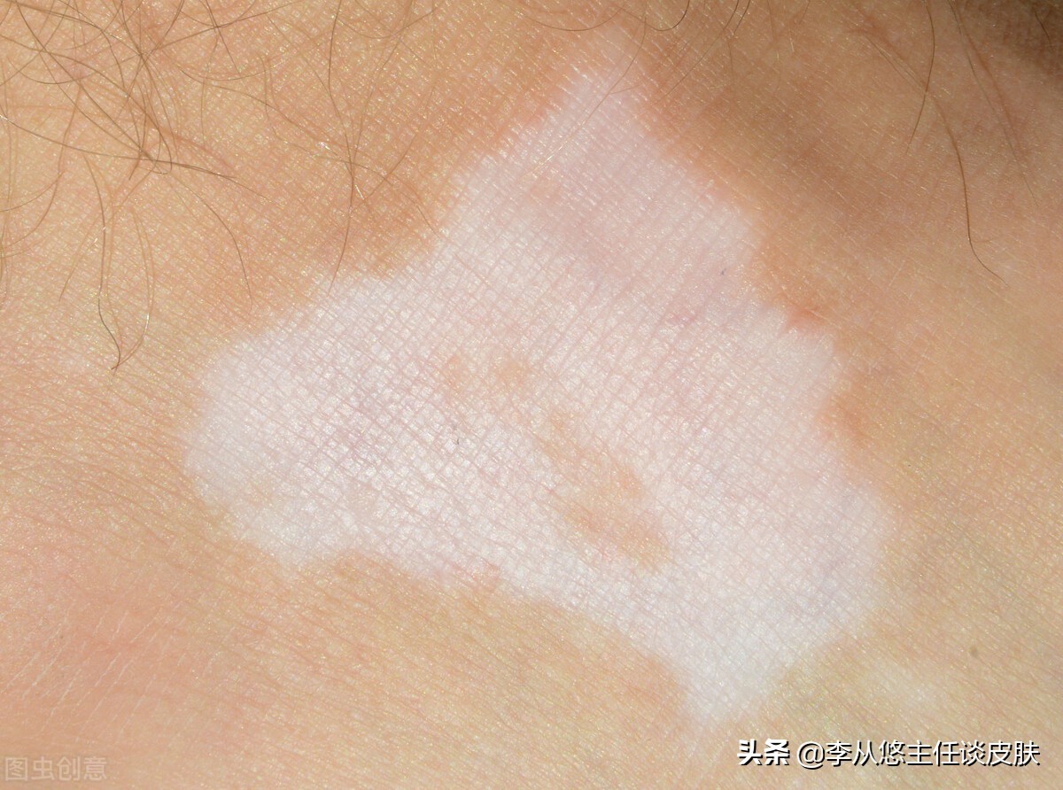 皮肤受伤后会得白癜风,皮肤损伤诱发白癜风的风险大吗