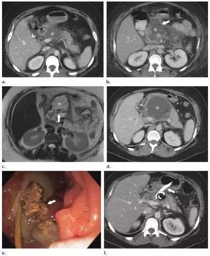 简述急性胰腺炎影像学表现,有关急性胰腺炎疼痛的图片