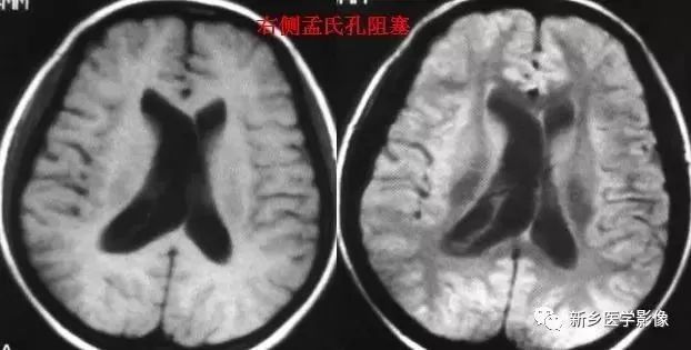影像学脑室扩大,脑室显大怎么理解