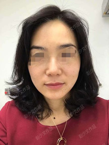 祛雀斑效果最好的方法,谁有亲身体验过的祛雀斑方法