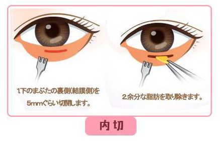 去严重眼袋最安全最有效的方法,年轻人去眼袋最安全最有效的方法