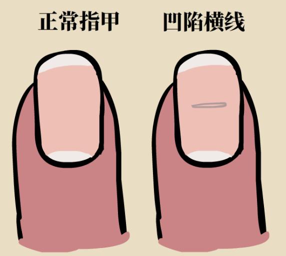 产后指甲出现小坑和凹痕,每个指甲中间都出现一条横凹痕