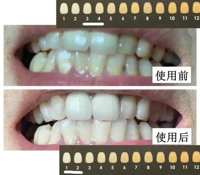 一张嘴就臭是咋回事,刷牙不管用的口臭怎么治