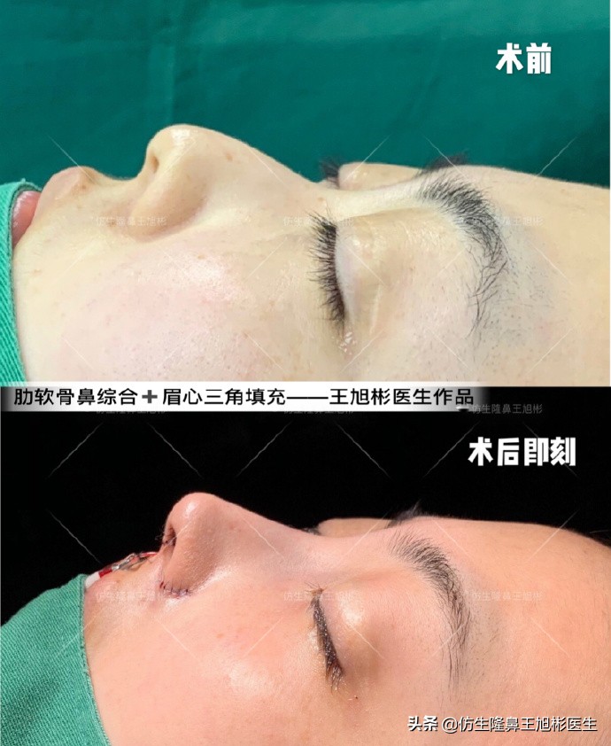 大鼻头能做直鼻微翘吗,可以只做鼻头缩小术吗