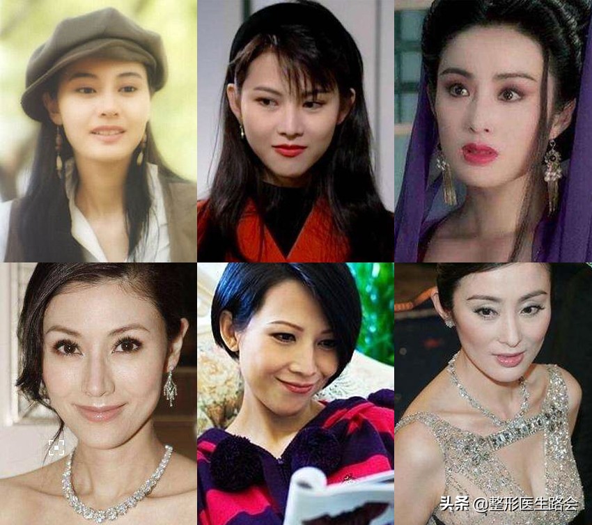 颧骨磨骨苹果肌下垂如何修复,如何判断是苹果肌还是高颧骨