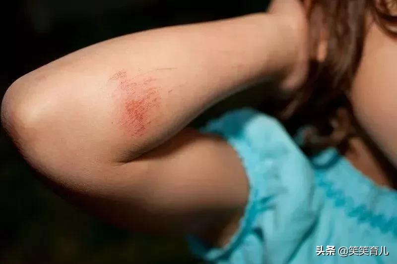 宝宝擦伤的正确处理方法,宝宝擦伤了该怎么办