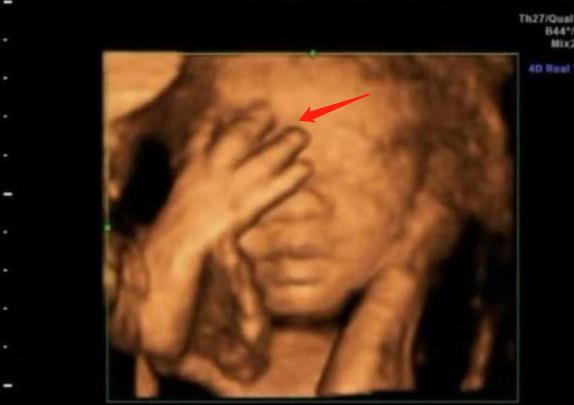 澶╂墠鑳庡効瀹岀粨,澶╂墠鑳庡効