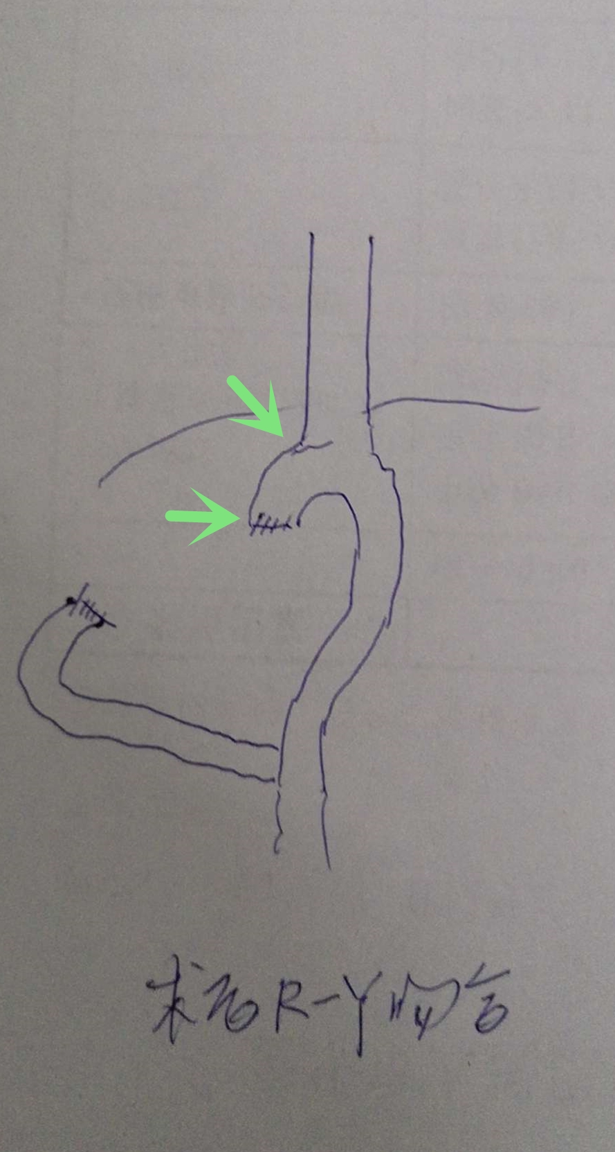 贲门癌80岁手术好还是保守治疗好,医生建议80岁老人做贲门癌手术