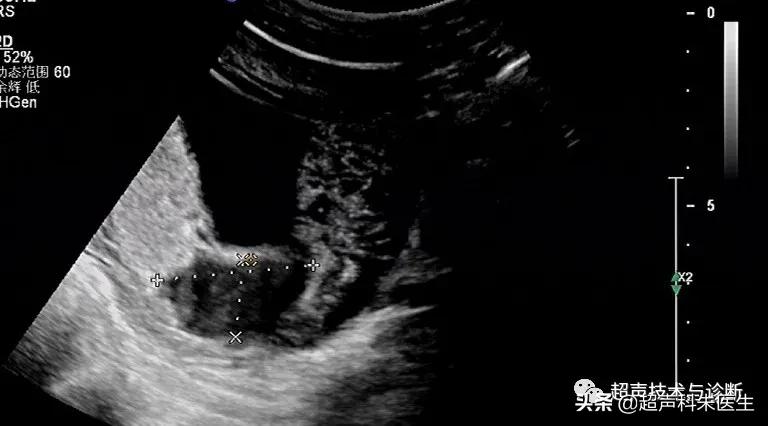 绒毛膜下血肿的超声鉴别诊断,绒毛膜下血肿的症状