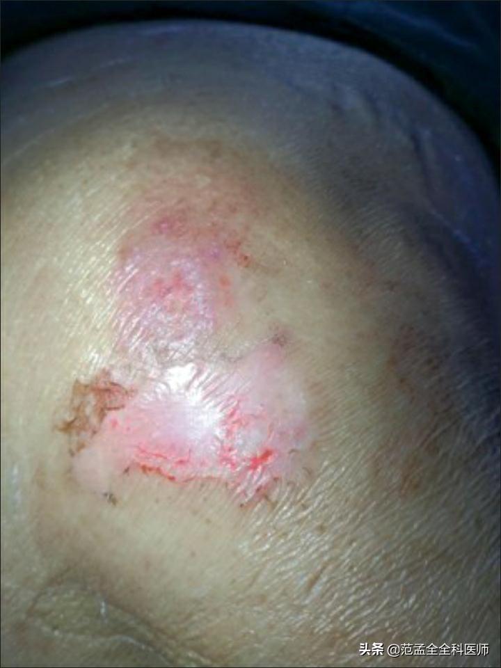 老年痴呆褥疮的护理和治疗,褥疮的护理建议和治疗方法推荐