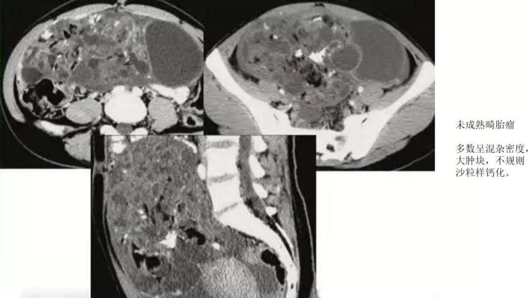 卵巢原发肿瘤的分析思路