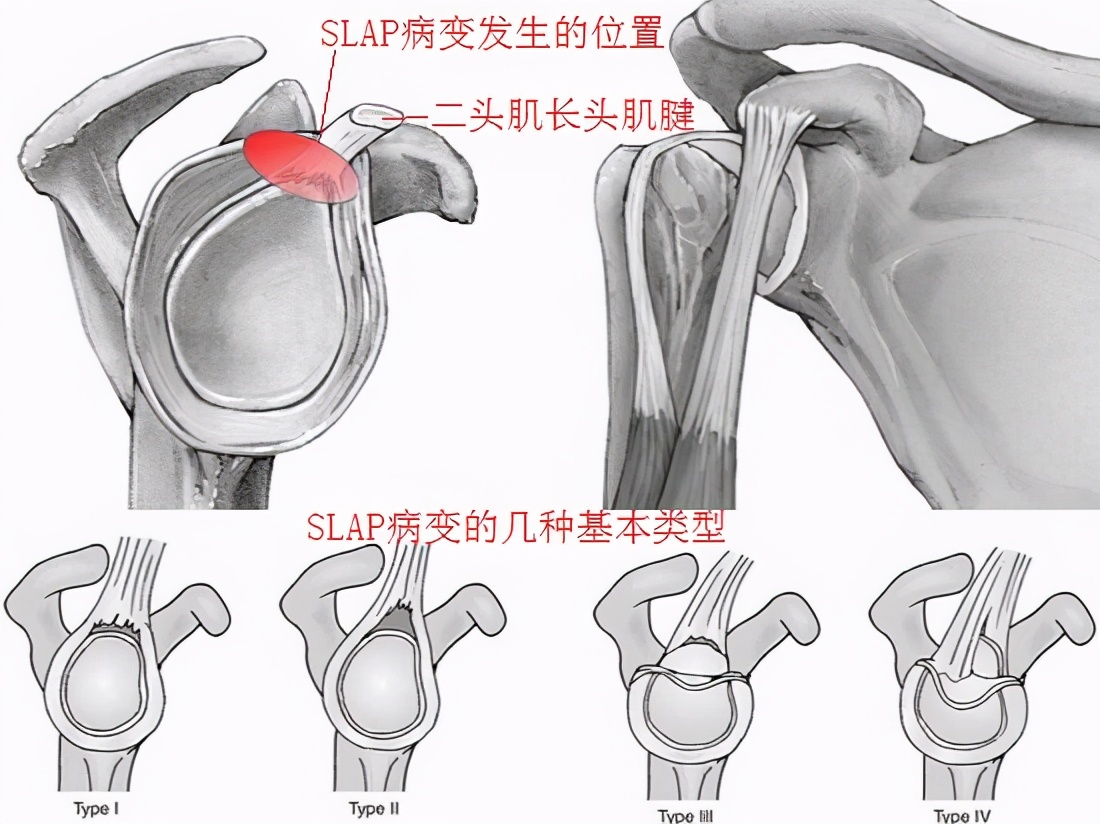 掰手腕导致肱二头肌肌腱损伤,肱二头肌肌腱损伤推拿治疗