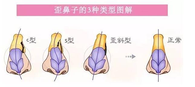 余文林鼻子好不好,余文林鼻子矫正