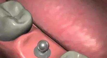 3d打印种植牙与传统种植牙的区别,种植牙是怎样种植的如何操作
