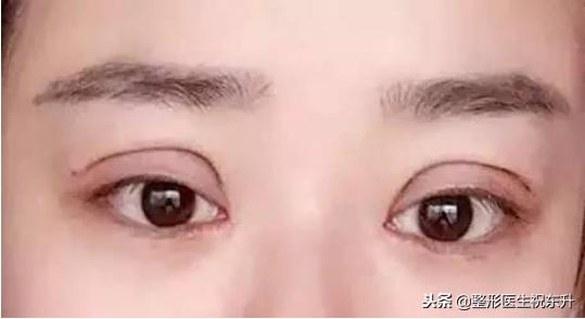 割双眼皮后怎样可以尽快完全恢复,割双眼皮的危害老了以后会怎样