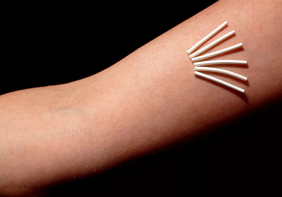 在美国做手术,在美国做什么避孕手术