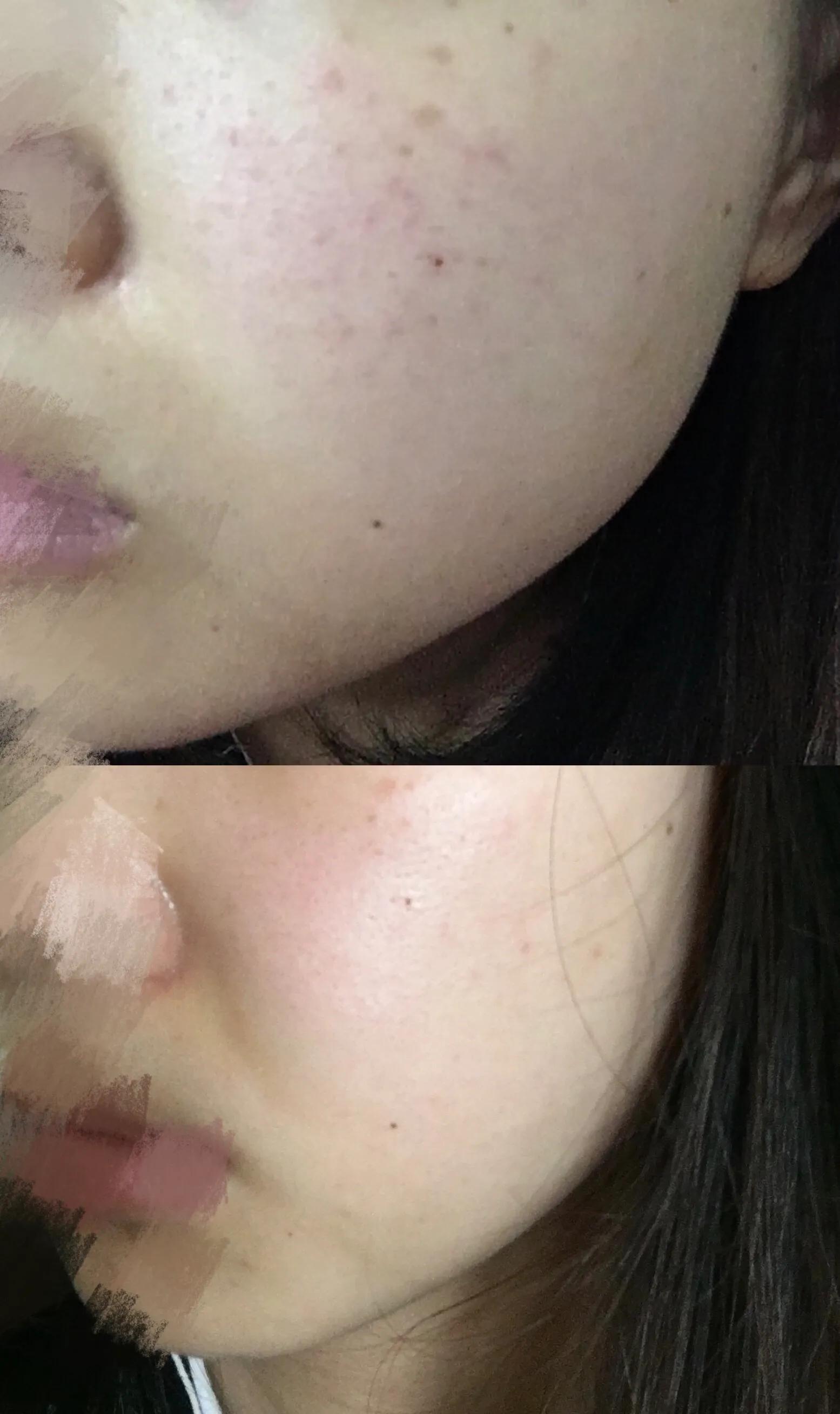 公认最好的祛痘印产品,祛痘印痘坑用什么产品最好