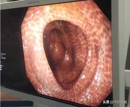 湖南一女子吃两年芦荟胶囊导致肠道长“豹纹”！别再靠吃泻药减肥啦