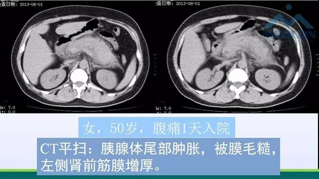 急性胰腺炎的护理措施,急性胰腺炎影像与临床