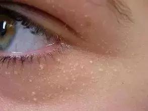 老中医教你一招彻底解决脂肪粒,脸上长脂肪粒怎么解决