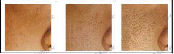 毛孔粗大抗炎,油脂性毛孔粗大怎么抗老