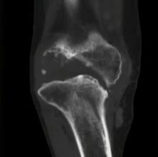 关节炎与痛风性关节炎有什么区别,关于痛风的30个辟谣的问题