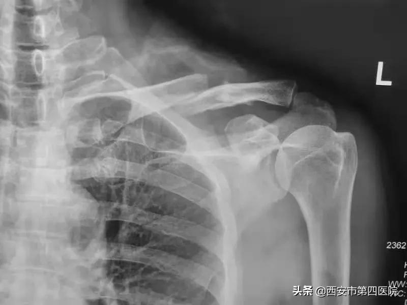 锁骨骨折保守治疗84天,公立医院锁骨骨折手术