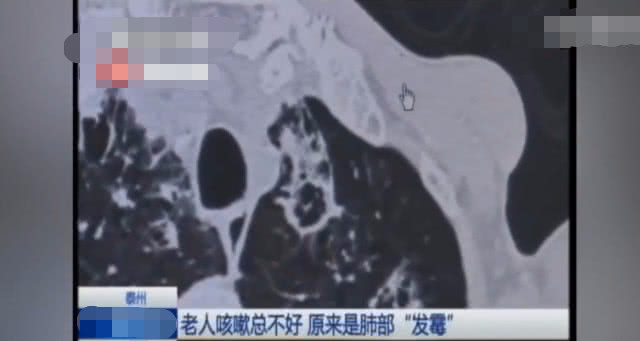 老年人咳嗽痰液粘稠而不易咳出,老人咳嗽一年多了老不好怎么回事