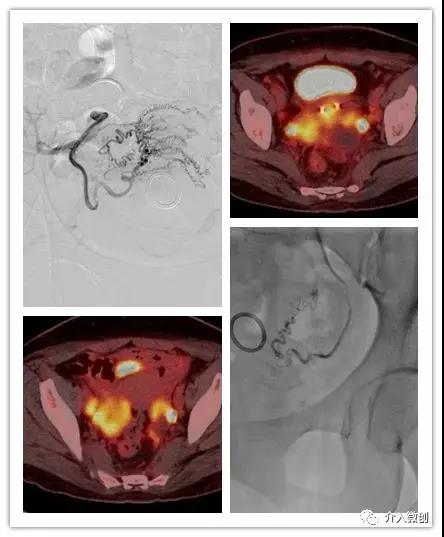 中晚期宫颈癌最佳方法,七十老人宫颈癌中晚期怎么治疗好