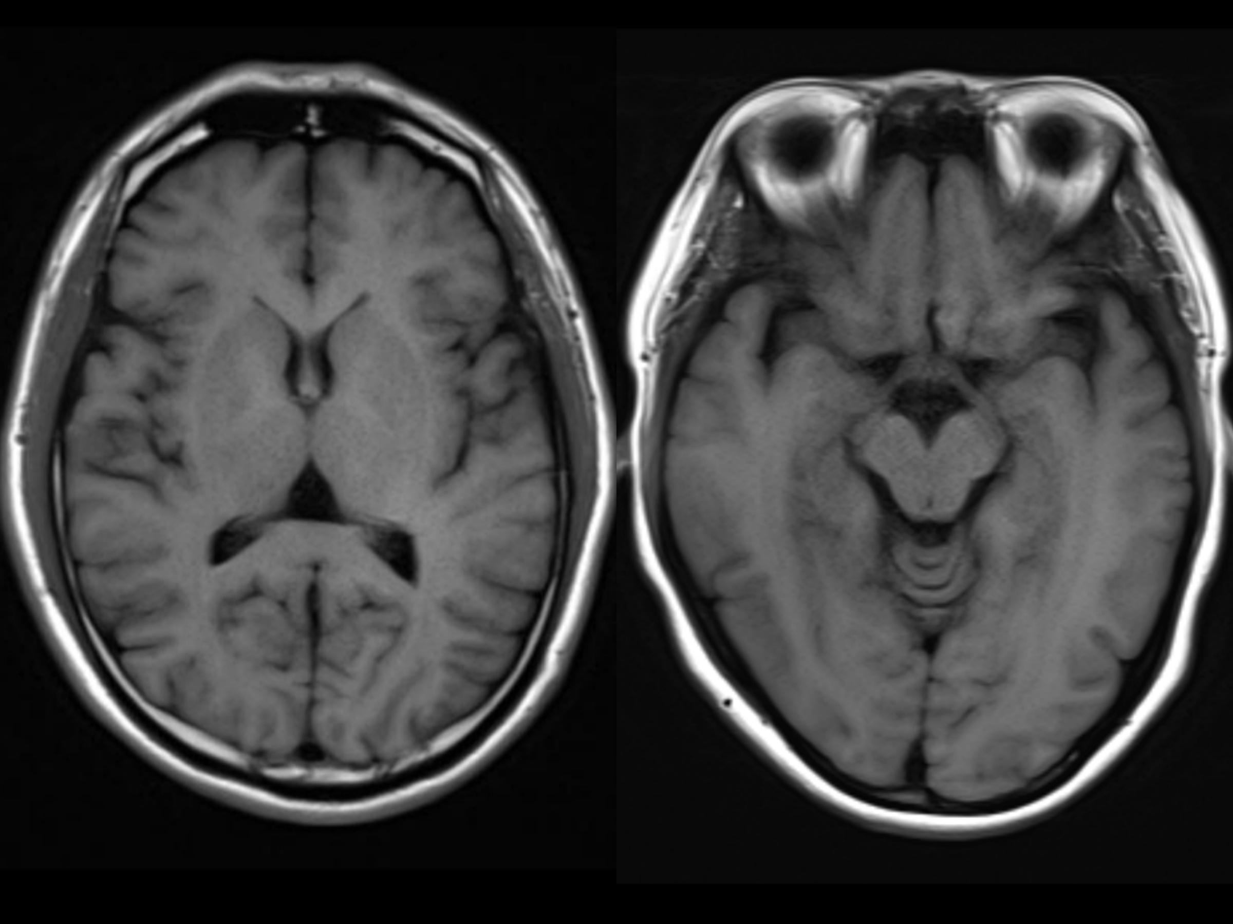 脑萎缩是什么病的征兆,什么叫脑萎缩有哪些症状