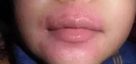 嘴唇干爆皮唇炎用什么药膏,唇炎一直嘴唇干裂起皮什么原因