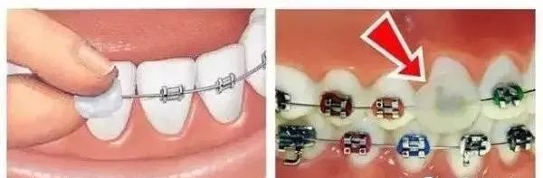 超详细的初戴正畸牙套的注意事项,戴全瓷牙套后需要注意什么