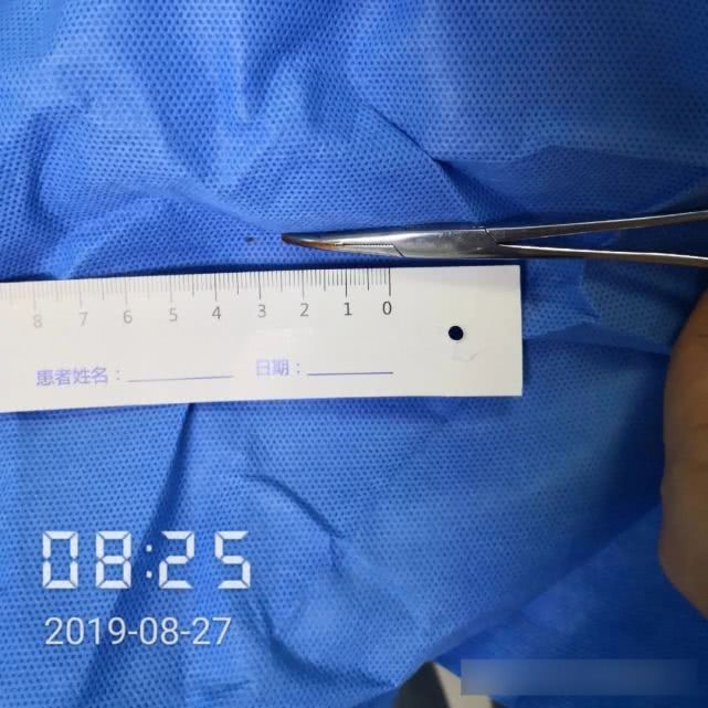 阑尾炎形成窦道的原因,阑尾炎一孔微创手术全过程