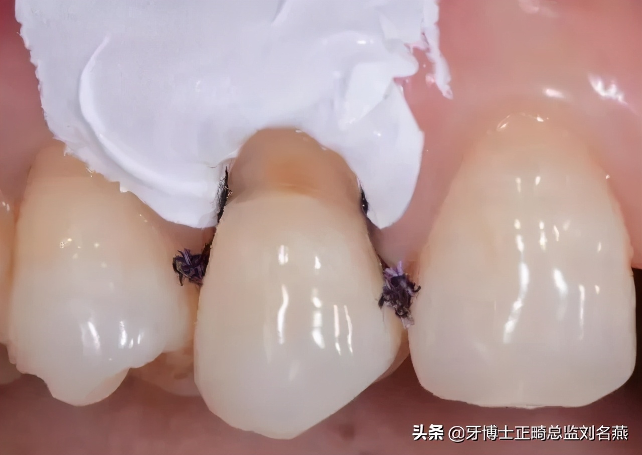 楔状缺损怎么修补,楔状缺损充填视频