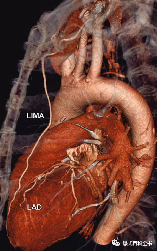 ct排数和层数区别,ct排与层的区别