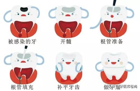 蛀牙很深但是不痛需要根管治疗吗,蛀牙根管治疗是什么样的