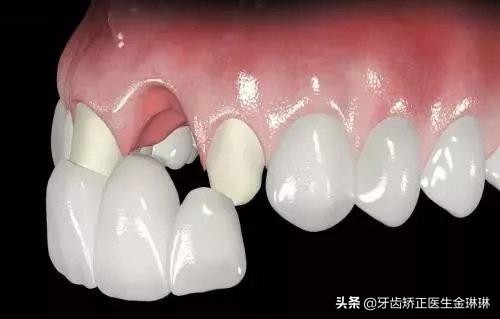 烤瓷牙不密合怎么办,烤瓷牙边缘不密合了怎么处理