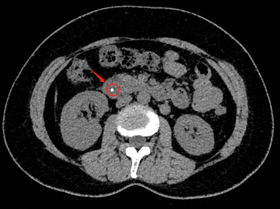 美女体内取出虫能致癌吗,女子体内取出活虫吃了什么菜