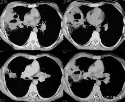男性65岁咳嗽咳痰2个月病例,男的咳嗽被查出肺癌