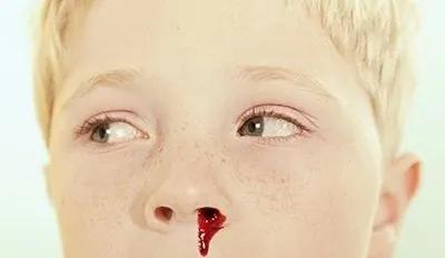 白血病腿疼和发烧是同时进行的吗,白血病出现小腿红肿热是初期吗