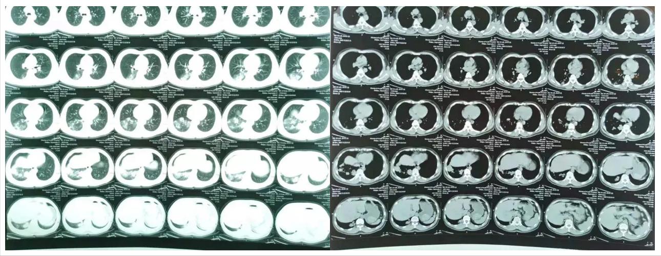 肺炎治疗7天症状好转ct无好转,肺炎治快二个月还没好