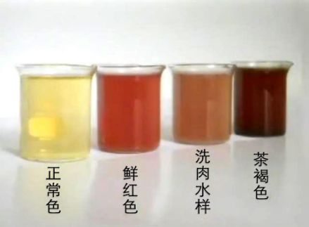 放疗后尿频尿急尿不尽原因,放疗导致的尿频多久能好