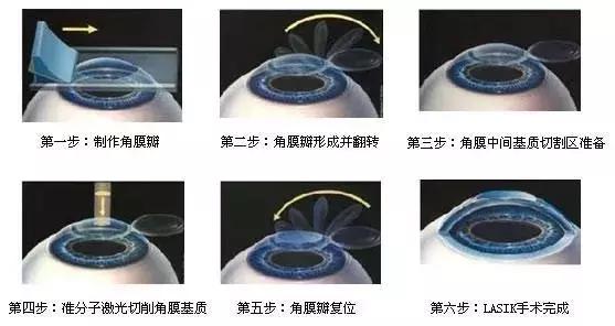 激光近视手术切了什么,激光近视手术的切口是怎么愈合的