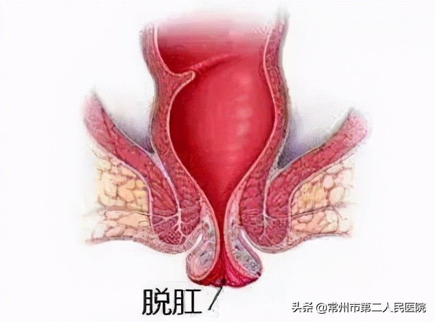 脱肛直肠坏死的早期症状,直肠脱垂有肉球脱出吗