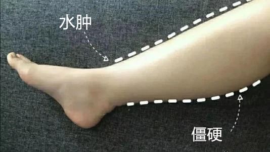 为什么一上班就全身水肿,夏天经常水肿腿是什么原因造成的