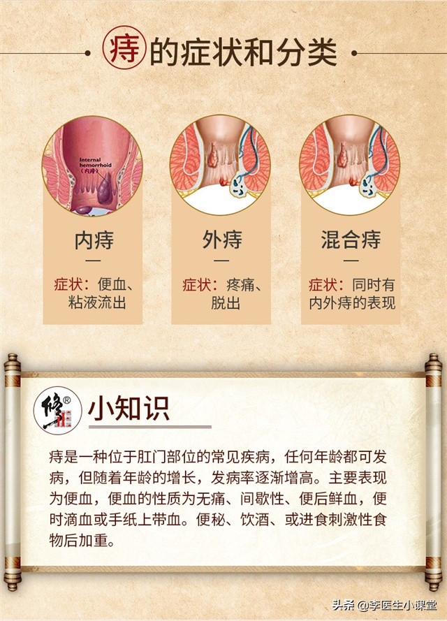 用痔疮药膏可以消除痔疮肉球吗,怎么办才能使痔疮的小肉球消退