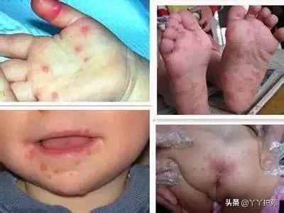 儿科常见出疹性疾病,儿科常见出疹性疾病有哪些